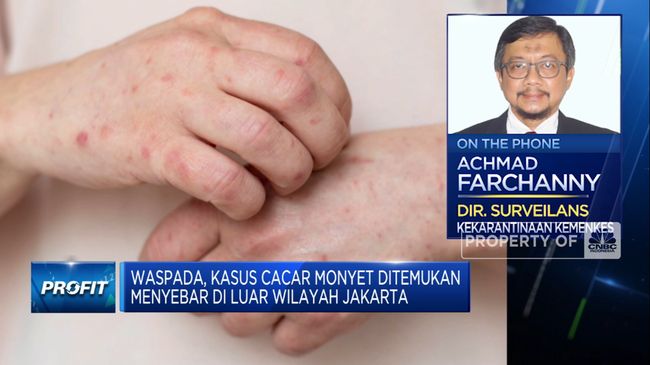 Cegah Cacar Monyet Meluas, Kemenkes Siapkan Obat & Vaksinasi