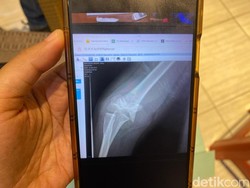 Anak Dibully hingga Patah Tulang, Ayah: Dia Ketakutan Saat Mau Sekolah