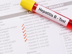 Mengenal Tes HBsAg untuk Deteksi Penyakit Hepatitis B