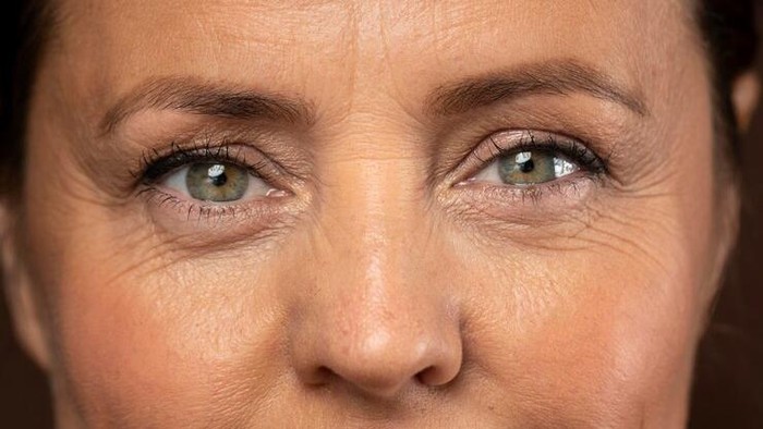 Sering Dikira Sama, Yuk Ketahui Perbedaan Fine Lines dan Wrinkle!