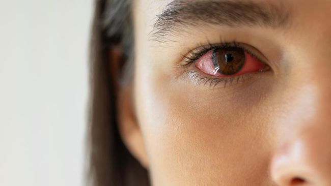 Jika menemukan tanda berikut, bisa jadi mata merah mengarah pada masalah lebih serius sehingga perlu cek ke dokter.