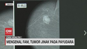 VIDEO: Mengenal Fam, Tumor Jinak Pada Payudara