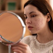 6 Cara Menghilangkan Jerawat Batu Secara Alami dan Bisa Dilakukan di Rumah