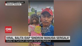 VIDEO: Viral, Balita Idap 'Sindrom Manusia Serigala'