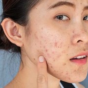 Kandungan Skincare yang Aman untuk Atasi Bruntusan