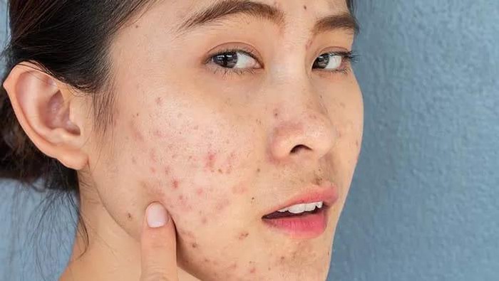 Kandungan Skincare yang Aman untuk Atasi Bruntusan
