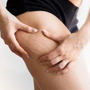 Kupas Tuntas Soal Stretch Mark dan Cara Mencegahnya