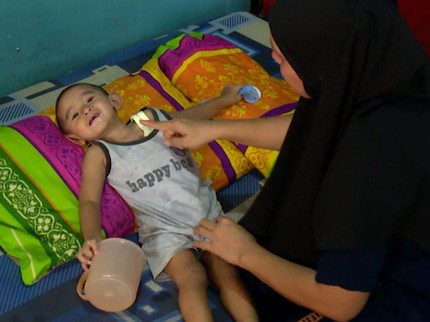 Tubuh Kecil Amar Tegar Didera Kelainan Jantung, Usus hingga Lambung