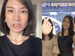 Before-After Viral Wanita Gagal Botox Berujung Tak Bisa Tertawa 4 Bulan