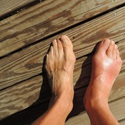 7 Cara Cepat Menghilangkan Nyeri Asam Urat Secara Alami