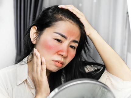 Wajah Kemerahan Setelah Pakai Produk Skincare, Harus Bagaimana? Cek Penyebab & Cara Mengatasinya