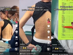 Viral Cerita Wanita yang Alergi 37 Makanan, Mengaku Tersiksa karena Ini