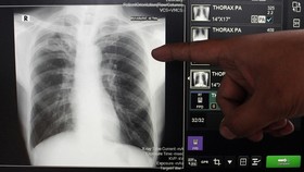Update TBC Indonesia: Lebih dari 1 Juta Kasus dan 125 Ribu Kematian