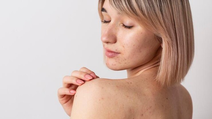 Ketahui Cara Efektif Menghilangkan Jerawat di Punggung agar Kulit Bisa Mulus