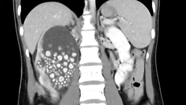 Understanding Kidney Stones Symptoms: Pain, Frequency, Urine Appearance, and More