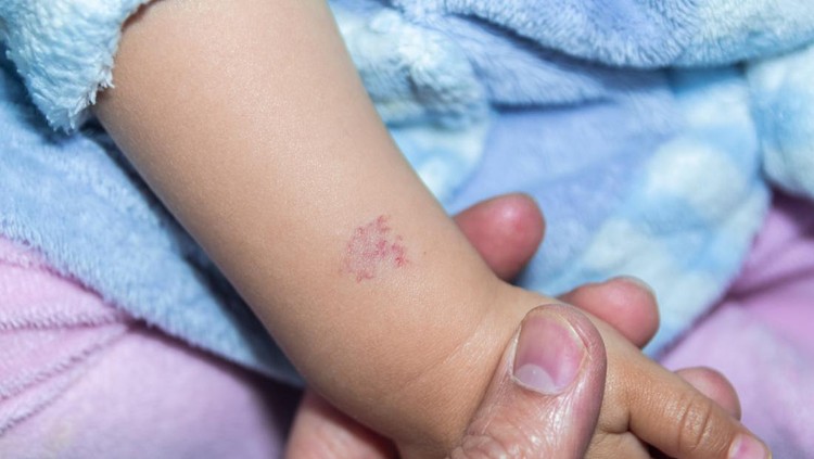 Tanda lahir biru memar pada anak