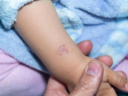 Tanda Lahir Biru Memar pada Anak, Apakah Bisa Hilang? Ini Penjelasan Medisnya