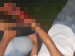 Hancur Jari Nasril Kena Ledakan Kembang Api di Malam Tahun Baru