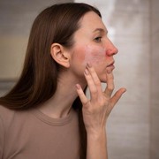 Say Goodbye to Acne, Ini Rekomendasi Obat Totol yang Ampuh Kempeskan Jerawat!