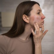 5 Penyebab Jerawat Gatal dan Penanganannya, Acne Prone Skin Wajib Tahu!