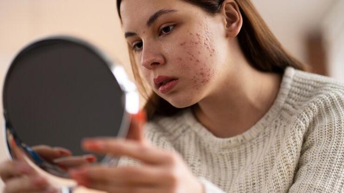 Kenali Penyebab Jerawat dari dari Posisinya di Wajah