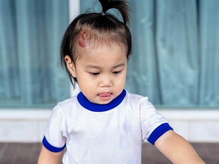 6 Jenis Tanda Lahir Anak yang Berbahaya dan Cara Mengatasinya