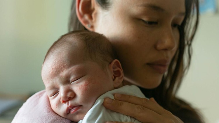 A depressed mother holding her baby with skin problems.