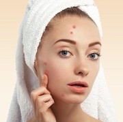 Pakai Acne Patch untuk Tutupi Jerawat Kini Jadi Tren, Apa Saja Manfaatnya Ya?