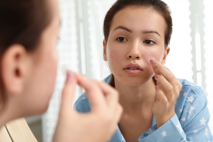Acne Patch untuk Tutupi Jerawat Jadi Tren, Apa Manfaatnya?