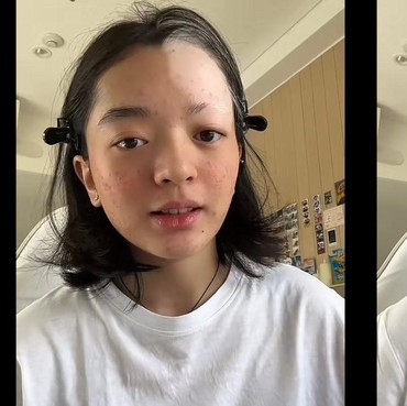 Pengertian Vitiligo seperti yang Diidap Wanita Jakbar usai Bleaching Rambut