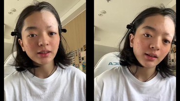 img-title Pengertian Vitiligo seperti yang Diidap Wanita Jakbar usai Bleaching Rambut