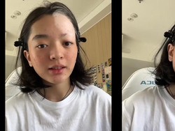 Pengertian Vitiligo seperti yang Diidap Wanita Jakbar usai Bleaching Rambut