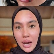 Mengenal Penyebab dan Gejala Sindrom Stevens Johnson, Penyakit yang Diderita Artis Kartika Putri