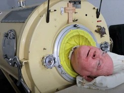 Manusia 'Paru-paru Besi', Paul Alexander Meninggal Dunia