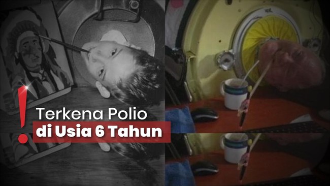 Paul Alexander Meninggal Dunia Usai 72 Tahun Ditopang Paru-paru Besi