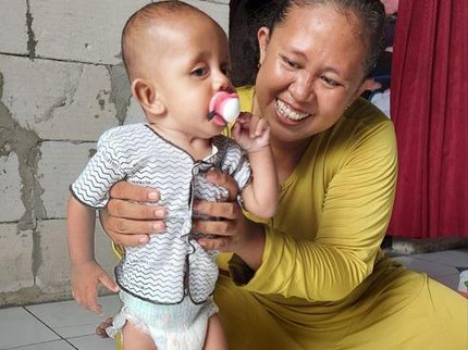 Merana Anak Tukang Somay, Alami Stunting dan Masalah pada Usus