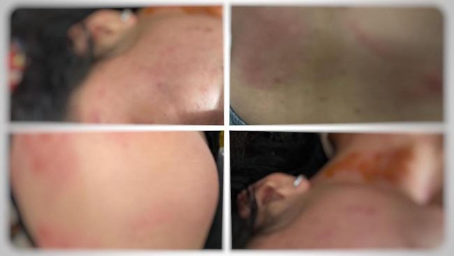 7 Cara Alami Mengatasi Lebam agar Cepat Hilang