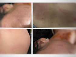 7 Cara Alami Mengatasi Lebam agar Cepat Hilang