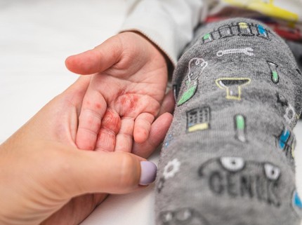 9 Ciri-ciri Flu Singapura pada Bayi, Gejala, Penyebab, dan Cara Mengatasinya
