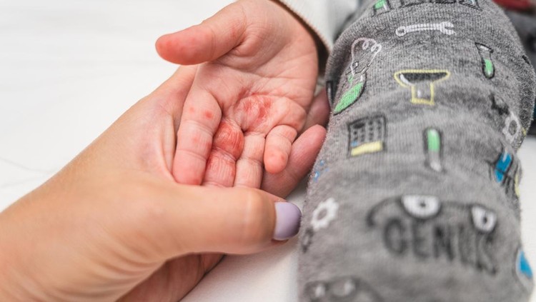 Close up enterovirus on baby body