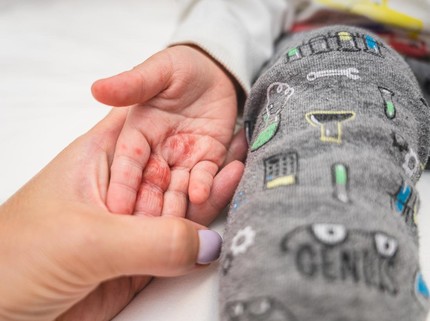 Waspada Penularan Flu Singapura pada Anak, Kini Tembus 5 Ribu Kasus di Indonesia
