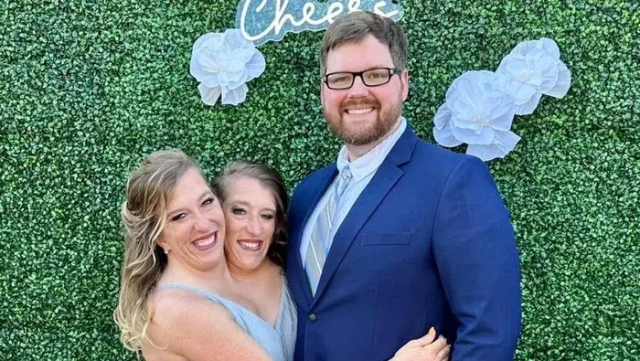 Viral! Perempuan Kembar Siam Abby Hensel Sudah Nikah, Suaminya Veteran Angkatan Darat AS