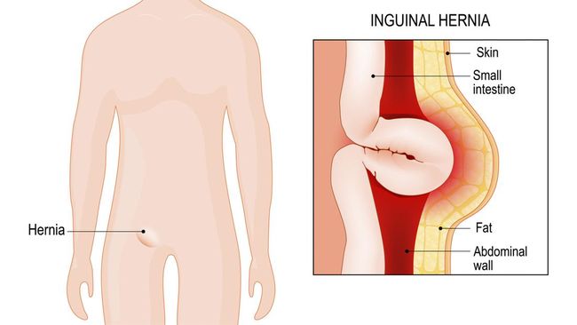 Bila kondisi hernia sudah parah, maka perlu dilakukan tindakan operasi. Lantas, apakah operasi hernia bisa ditanggung BPJS Kesehatan?