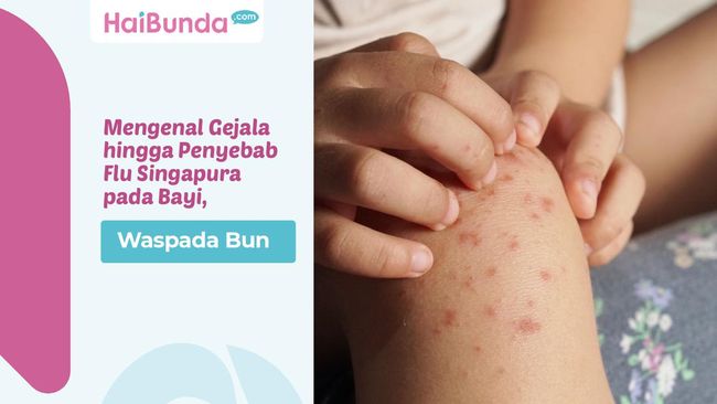 Mengenal Gejala hingga Penyebab Flu Singapura pada Bayi, Waspada Bun