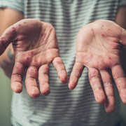 Masih Banyak yang Salah Kaprah, Flu Singapura Bukan Flu dan Bukan Asli Singapura! Ini Penjelasannya