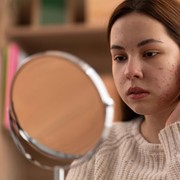 Mengenal Close Komedo dari Ciri-ciri, Cara Menghilangkan, dan Pilihan Skincare Terbaiknya