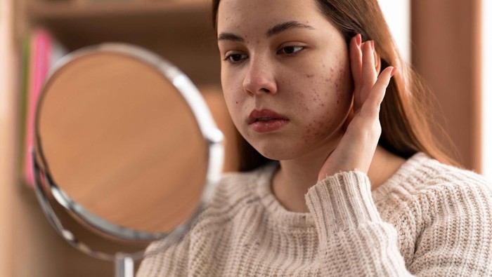 Mengenal Close Komedo dari Ciri-ciri, Cara Menghilangkan, dan Pilihan Skincare Terbaiknya