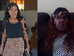 Nasib Wanita Idap Ribuan Tumor di Sekujur Tubuh, Susah Bernapas hingga Berjalan