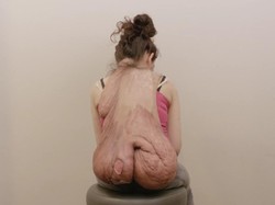 Kisah Alexandra Hidup Bersama Tumor Segede Semangka di Lehernya