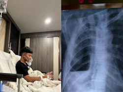 Gejala Awal Pria 18 Tahun Masuk RS usai Ngevape, Potret Paru-parunya Jadi Horor